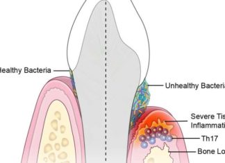 An unhealthy population of microbes in the mouth triggers specialized immune cells that inflame and destroy tissues