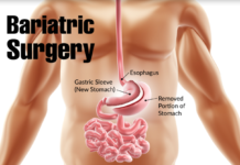 Measuring the percentage of weight regained following the maximum amount of weight lost after bariatric surgery can help predict a patient’s risk of several serious health problems