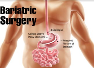 Measuring the percentage of weight regained following the maximum amount of weight lost after bariatric surgery can help predict a patient’s risk of several serious health problems
