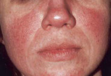 Caffeine intake from coffee is inversely associated with the risk for incident rosacea