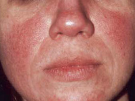 Caffeine intake from coffee is inversely associated with the risk for incident rosacea