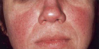 Caffeine intake from coffee is inversely associated with the risk for incident rosacea
