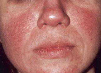 Caffeine intake from coffee is inversely associated with the risk for incident rosacea