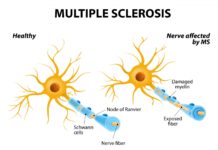 Certain environmental conditions may lead to structural changes in the protective sheaths that cover nerve fibers and thus trigger multiple sclerosis