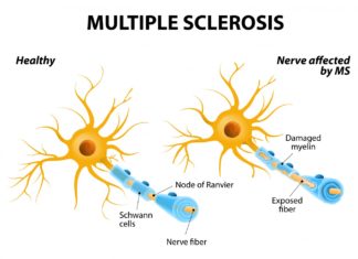 Certain environmental conditions may lead to structural changes in the protective sheaths that cover nerve fibers and thus trigger multiple sclerosis
