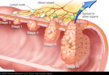 Colorectal cancer patients who followed healthy diets had a lower risk of death from colorectal cancer and all causes