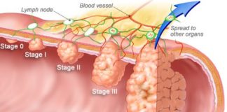 Colorectal cancer patients who followed healthy diets had a lower risk of death from colorectal cancer and all causes