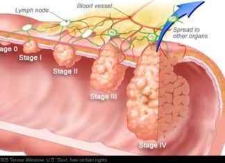 Colorectal cancer patients who followed healthy diets had a lower risk of death from colorectal cancer and all causes