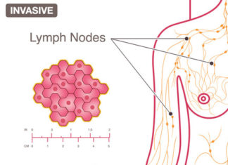 Breast cancer cells can physically push their way out of their normal confines to become invasive tumors