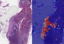 Google Claims Its AI Has 99% Accuracy In Detecting Metastatic Breast Cancer