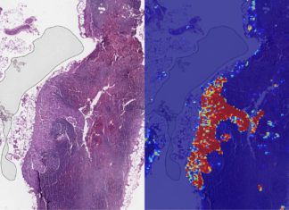 Google Claims Its AI Has 99% Accuracy In Detecting Metastatic Breast Cancer