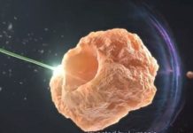 Lumenis, Israel-based firm, developed the world’s first holmium surgical laser to blast the urinary stones