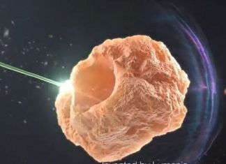 Lumenis, Israel-based firm, developed the world’s first holmium surgical laser to blast the urinary stones