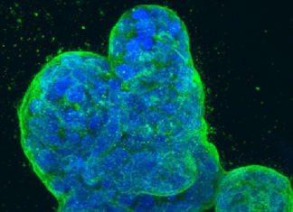New hope : First immunotherapy success for triple-negative breast cancer