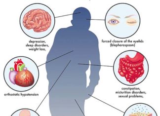 Parkinson’s disease : Study estimates 1 in 2 women and 1 in 3 men set to develop dementia