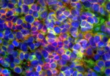Report : aggressive prostate and lung cancers are driven by common mechanisms