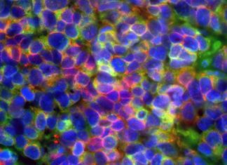 Report : aggressive prostate and lung cancers are driven by common mechanisms