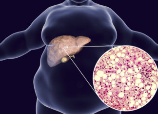 Research has found a previously overlooked group of obese people may be at risk of developing deadly liver cancer