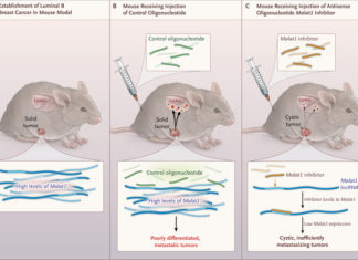 Researchers discovered that RNA (MALAT1) appears to suppress breast cancer metastasis