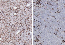 Research : Suppression of DKK3 protein thwarts pancreatic tumor progression and prolongs survival