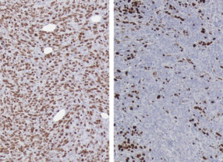 Research : Suppression of DKK3 protein thwarts pancreatic tumor progression and prolongs survival