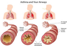 Toddlers with asthma are more likely to become obese children
