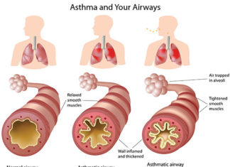 Toddlers with asthma are more likely to become obese children