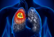 Women diagnosed with non-small cell lung cancers (NSCLC) live longer than their male counterparts