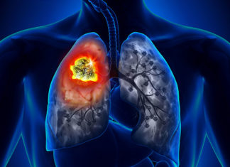 Women diagnosed with non-small cell lung cancers (NSCLC) live longer than their male counterparts
