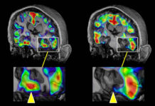 Only a small proportion of cases of dementia are thought to be inherited