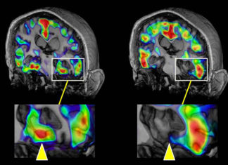 Only a small proportion of cases of dementia are thought to be inherited