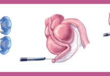Researchers report those who have had appendectomies have a reduced risk of developing Parkinson’s disease
