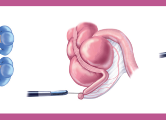 Researchers report those who have had appendectomies have a reduced risk of developing Parkinson’s disease