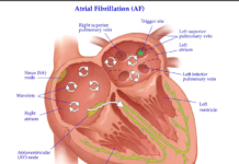 People with higher iron levels may be at greater risk of certain types of stroke