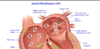 People with higher iron levels may be at greater risk of certain types of stroke