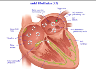 People with higher iron levels may be at greater risk of certain types of stroke