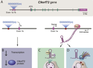 A genetic defect associated with als causes changes how cells starved of sugar metabolize fatty compounds known as lipids