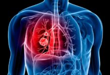 Use of angiotensin converting enzyme inhibitor drugs (ACEIs) to lower blood pressure is associated with an increased risk of lung cancer