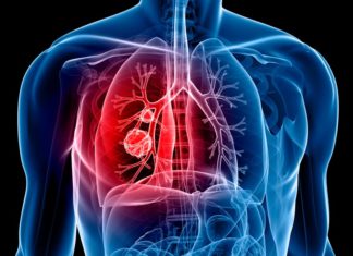 Use of angiotensin converting enzyme inhibitor drugs (ACEIs) to lower blood pressure is associated with an increased risk of lung cancer