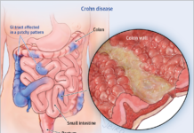 Crohn’s patients : researchers pinpointed a single molecule which predict whether a patient has subtype 1 or 2