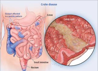 Crohn’s patients : researchers pinpointed a single molecule which predict whether a patient has subtype 1 or 2