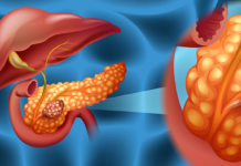 Why among several forms of pancreatic cancer one of them specifically affects young women ?