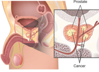 Treating the prostate with radiotherapy alongside standard treatment led to an 11 per cent increase in survival for some men with advanced prostate cancer
