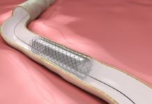 Researchers has created a new field probe for noninvasive and non-ionizing monitoring of the presence of metallic stents