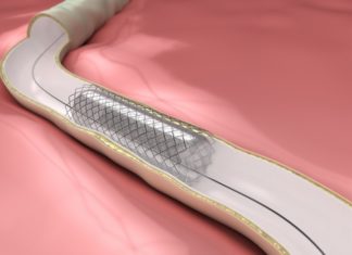 Researchers has created a new field probe for noninvasive and non-ionizing monitoring of the presence of metallic stents