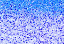 Researchers has isolated an enzyme that triggers an autoimmune response from T-cells in patients with MS