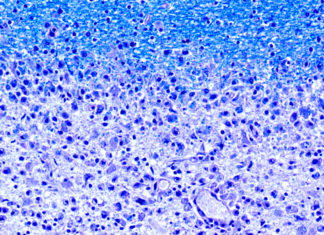 Researchers has isolated an enzyme that triggers an autoimmune response from T-cells in patients with MS
