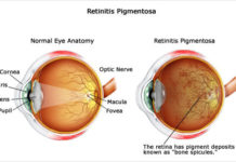 Mistakes in “proofreading” the genetic code of retinal cells is the cause of a form of inherited blindness