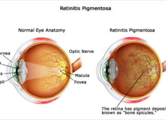 Mistakes in “proofreading” the genetic code of retinal cells is the cause of a form of inherited blindness