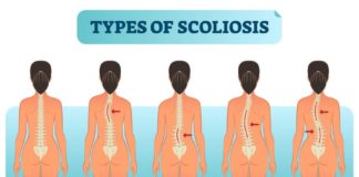 Body’s inability to fully utilize mineral manganese might be to blame for some cases of severe scoliosis